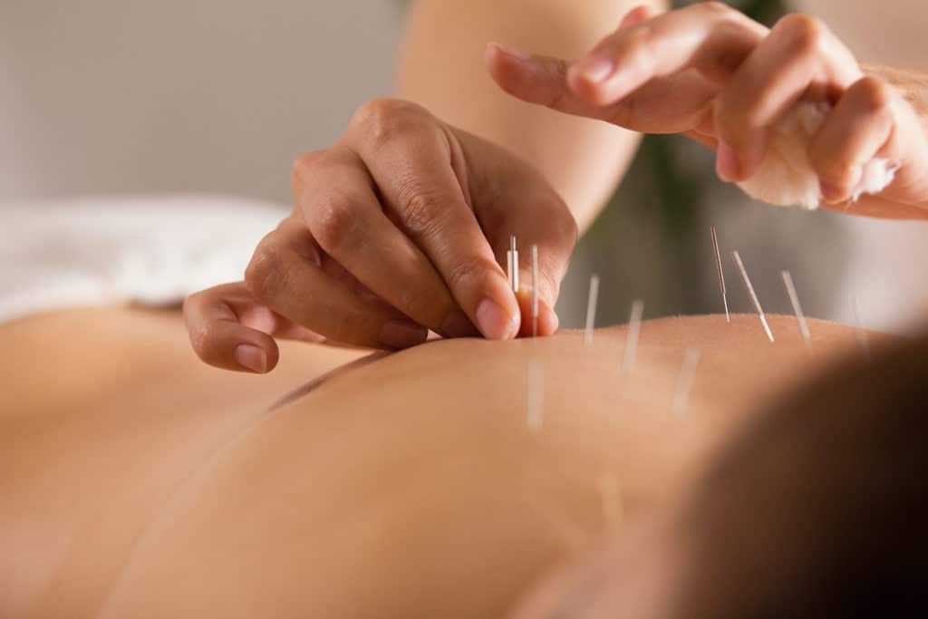 Acupuncture for Detox