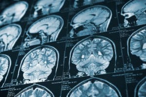 brain scan