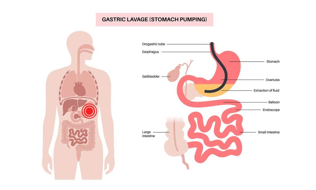 gastric lavage